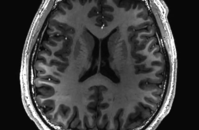 科学家揭秘：安慰剂效应背后的大脑回路_科学家揭秘：安慰剂效应背后的大脑回路_