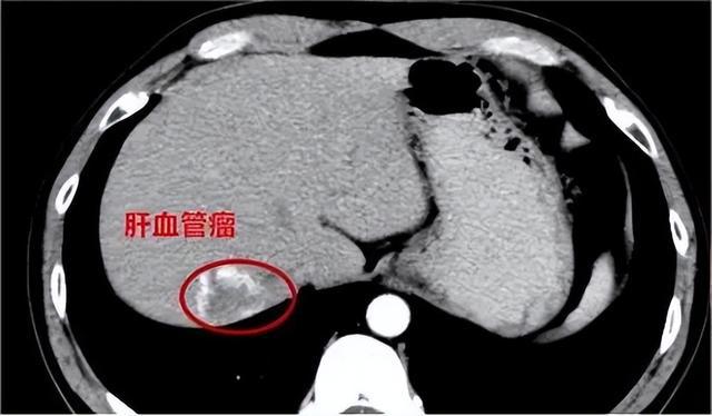 豆腐渣瘤手术要住院么_血管外皮瘤_