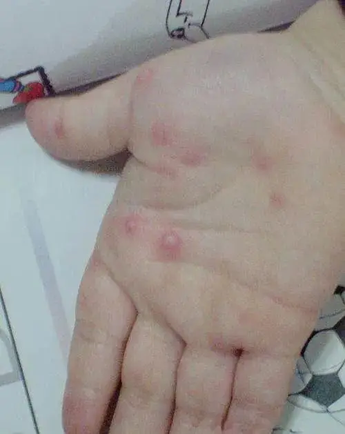 大学新生入学疫苗__大学生开学接种疫苗