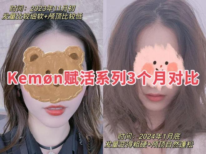 推广|| 用了5年才来推荐，多亏它保住我的发际线__推广|| 用了5年才来推荐，多亏它保住我的发际线